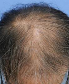 Dクリニック新宿で治療を受けた50代 MO型の男性の頭部ビフォーイメージ