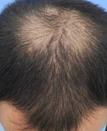 Dクリニック新宿で治療を受けた30代 O型の男性の頭部ビフォーイメージ