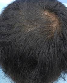 Dクリニック新宿で治療を受けた40代 MO型の男性の頭部アフターイメージ