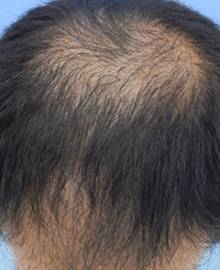 Dクリニック新宿で治療を受けた40代 MO型の男性の頭部ビフォーイメージ