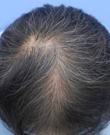 Dクリニック新宿で治療を受けた50代 MO型の男性の頭部アフターイメージ